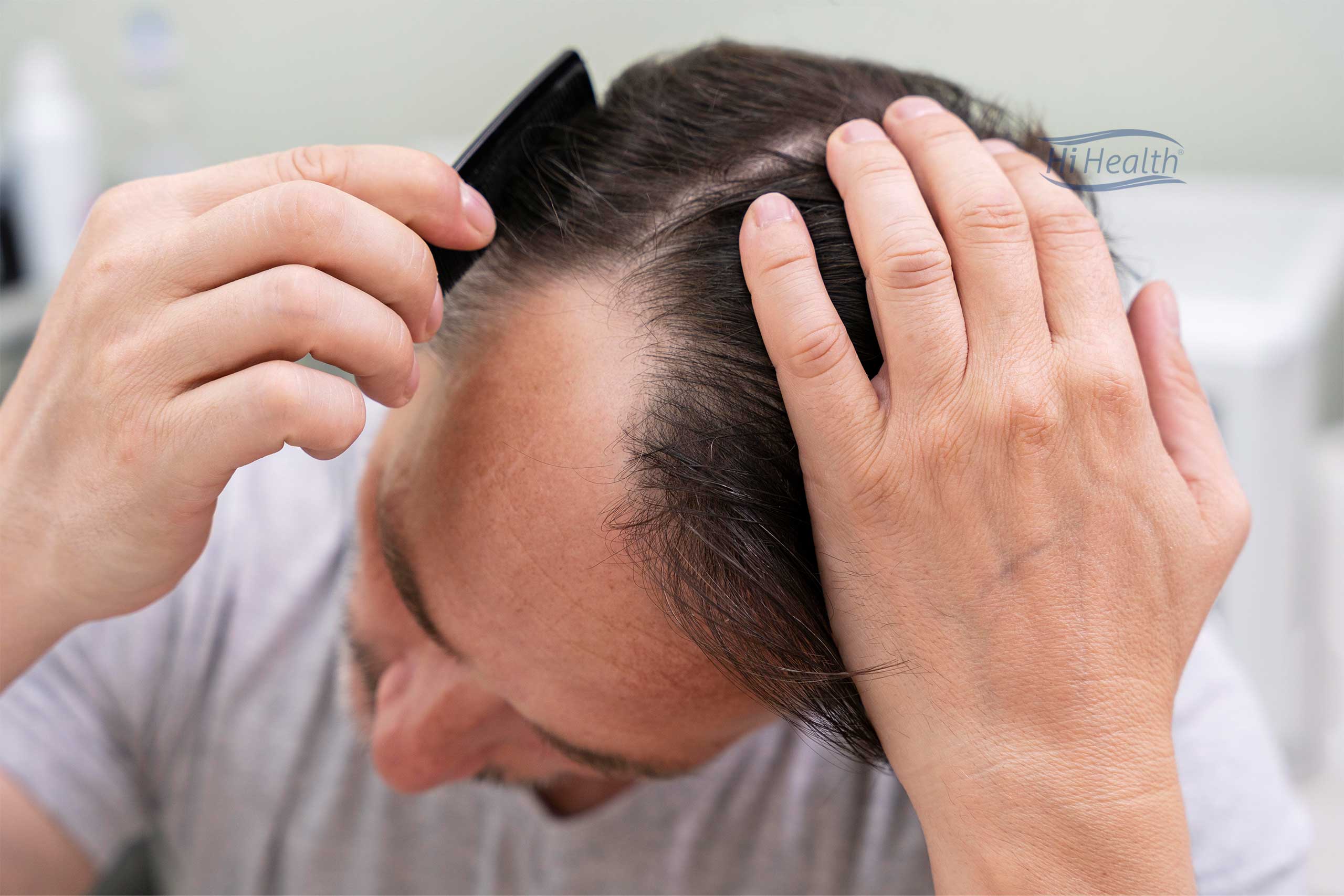 ریزش مو و عوامل موثر بر ریزش مو و درمان آن
